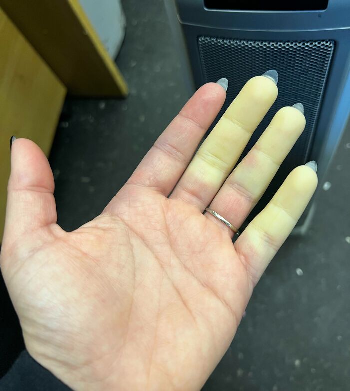 Close-up of a hand showing rare body condition with pale fingers, illustrating surprising things about bodies.
