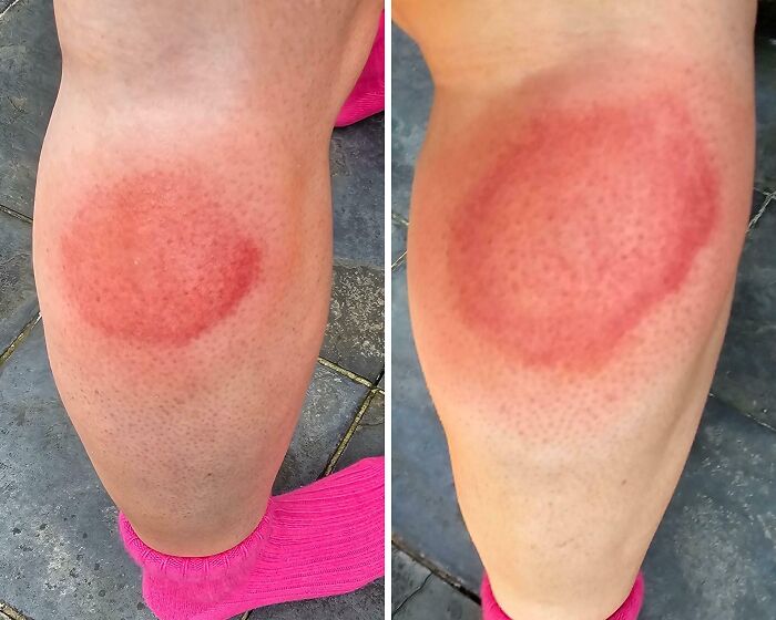 Red circular rash on a person's leg showing a rare and surprising skin condition related to the body.