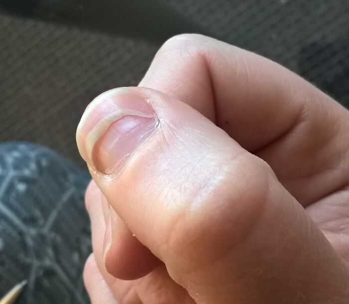Close-up of a thumb with a rare nail shape, highlighting surprising and rare things about bodies.