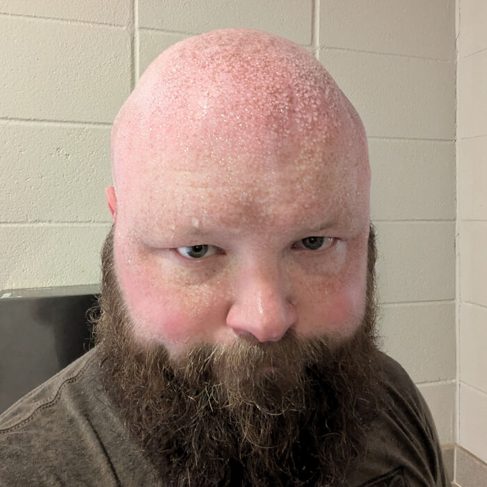 Close-up of a man with a rare skin condition causing textured bumps on his bald head, sharing surprising body features.