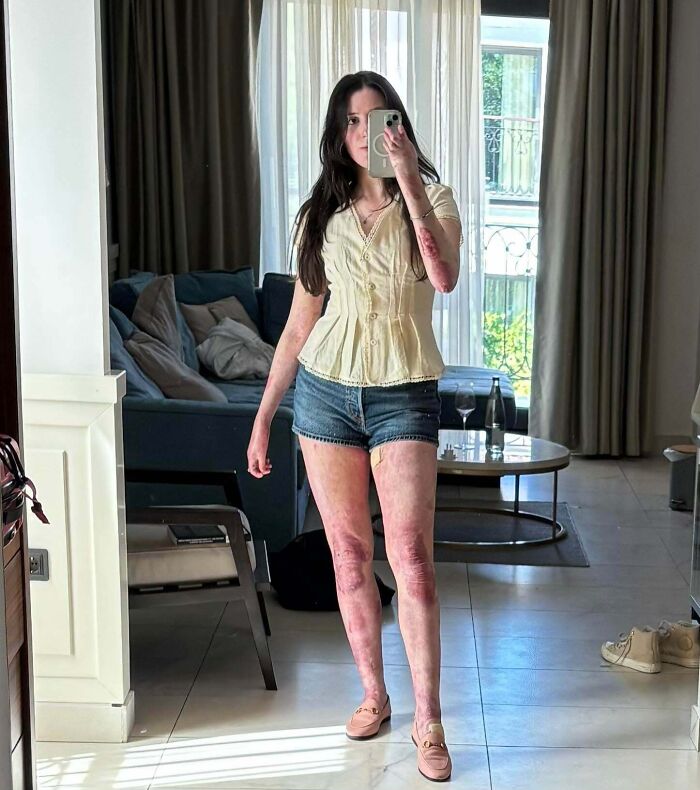 Young woman taking a mirror selfie showing rare and surprising skin condition on her arms and legs indoors.