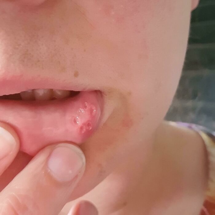 Close-up of rare and surprising bumps inside a person’s lip showing unusual body features.