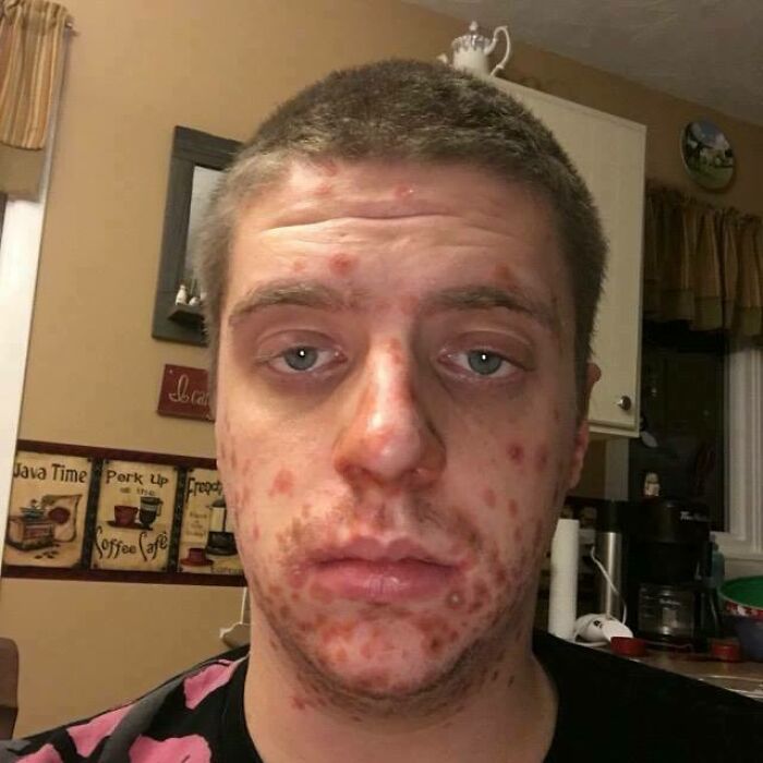 Young man with rare skin condition showing red spots and marks on face, highlighting surprising things about their bodies