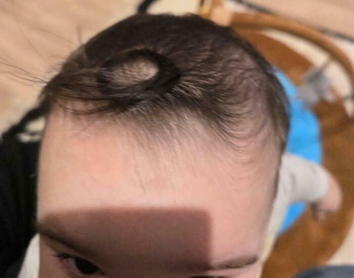 Close-up of a person's forehead showing a rare hair pattern, highlighting surprising details about their bodies.