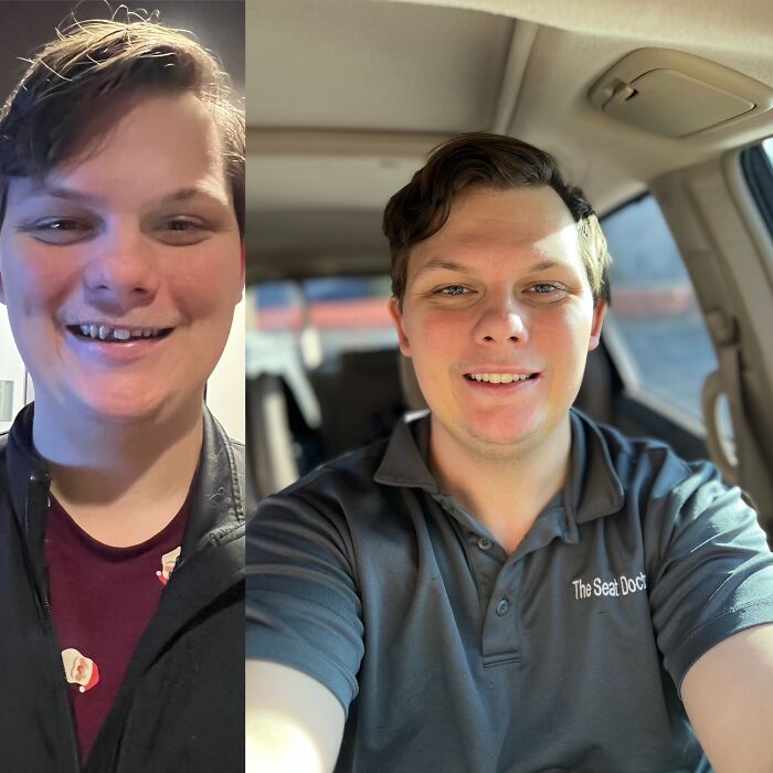 Before and after photos of a young man showing a life-changing transformation with a bright smile and confident appearance.