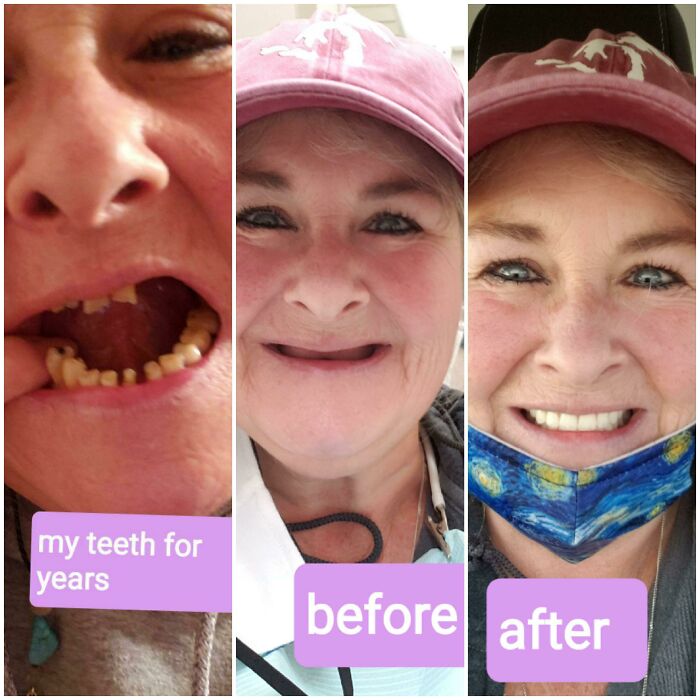 Woman showing dental transformation with before and after photos highlighting life-changing transformations.