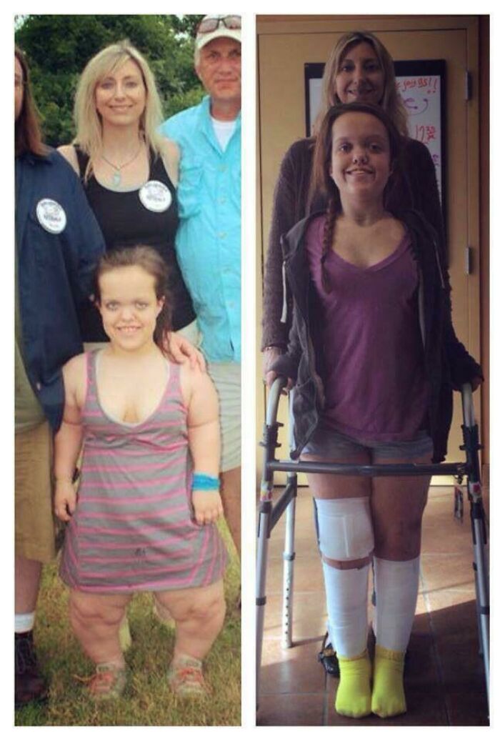 Young woman showing inspiring physical transformation using walker and leg braces, highlighting life-changing transformations revealed by people.