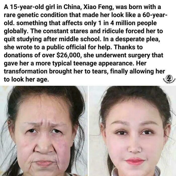 Before and after photos of a girl with a rare genetic condition, showing inspiring transformation and hope beyond the news.