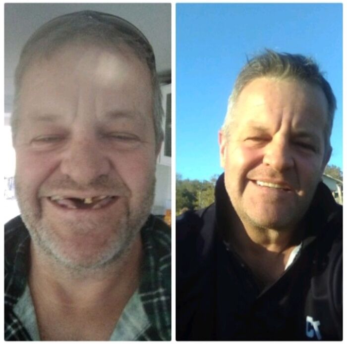 Before and after photos of a man showing one of the best glow-ups with improved teeth and a brighter smile outdoors.