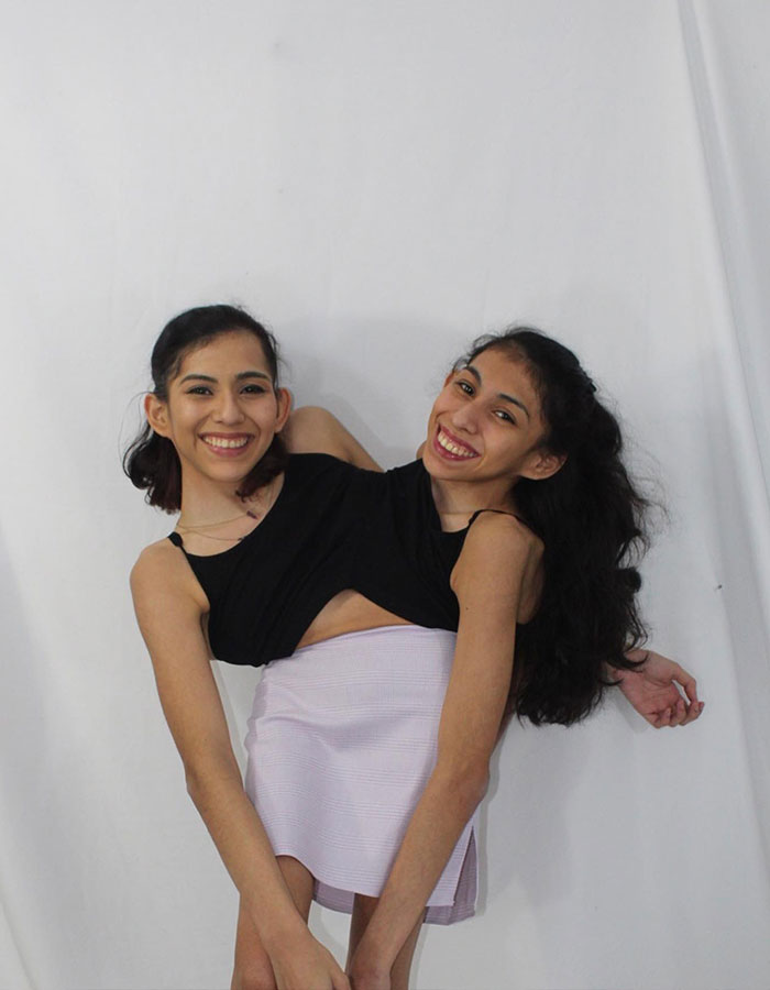 Conjoined twin Carmen Andrade smiling and posing against a plain white background, showcasing confidence and strength.