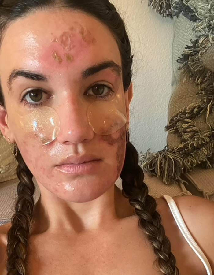 Woman with facial skin damage and patches, highlighting permanent disfigurement after celebrity facialist treatment claims.