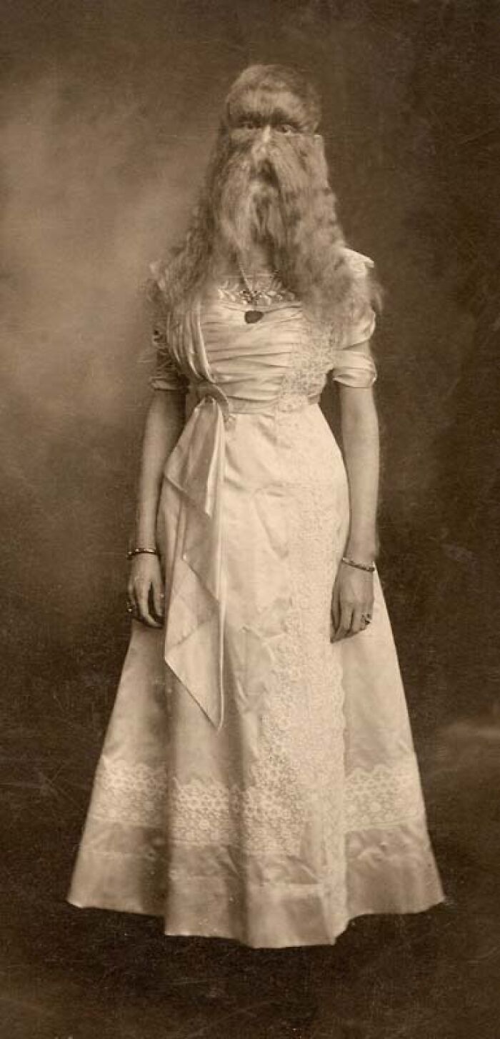Woman with rare and surprising body condition covered in hair, wearing a vintage dress in an old sepia photograph.