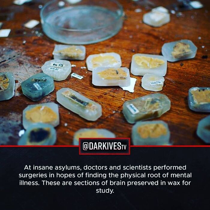 Sections of brain preserved in wax on a table, related to terrifying and dark medical practices in strange history.