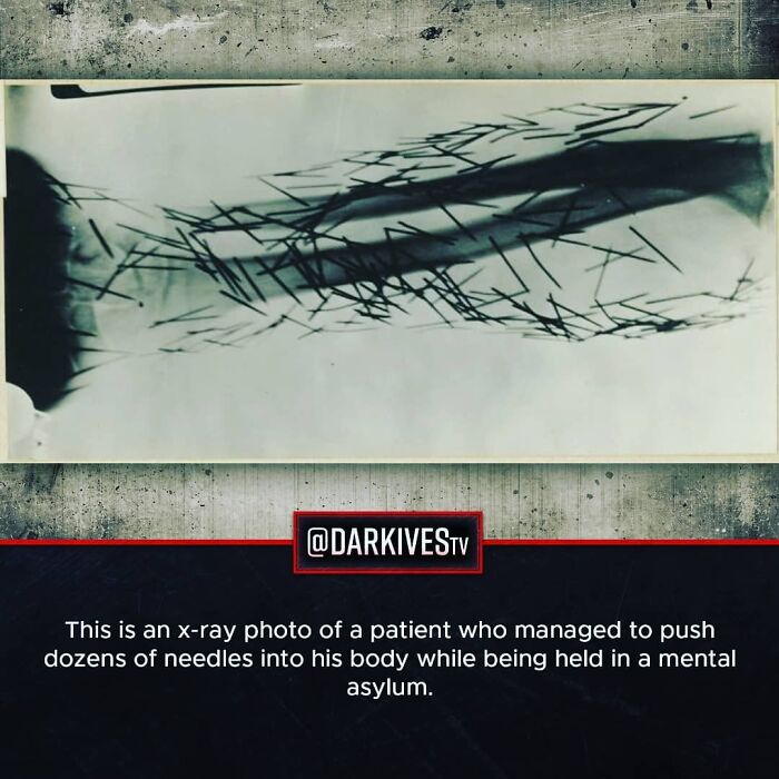 X-ray of a patient with dozens of needles pushed into their body, illustrating strange and dark real-life facts.