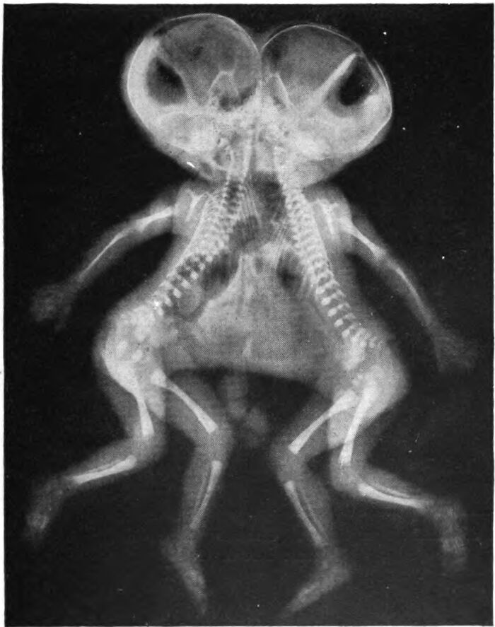 X-ray image showing a rare disease case with conjoined skeletal structures encountered by doctors.
