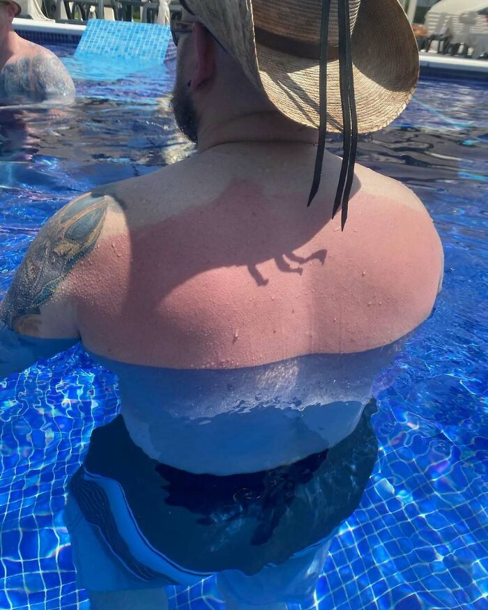 Man in pool with severe sunburn shaped like a swimsuit, illustrating worst luck on vacation mishap.