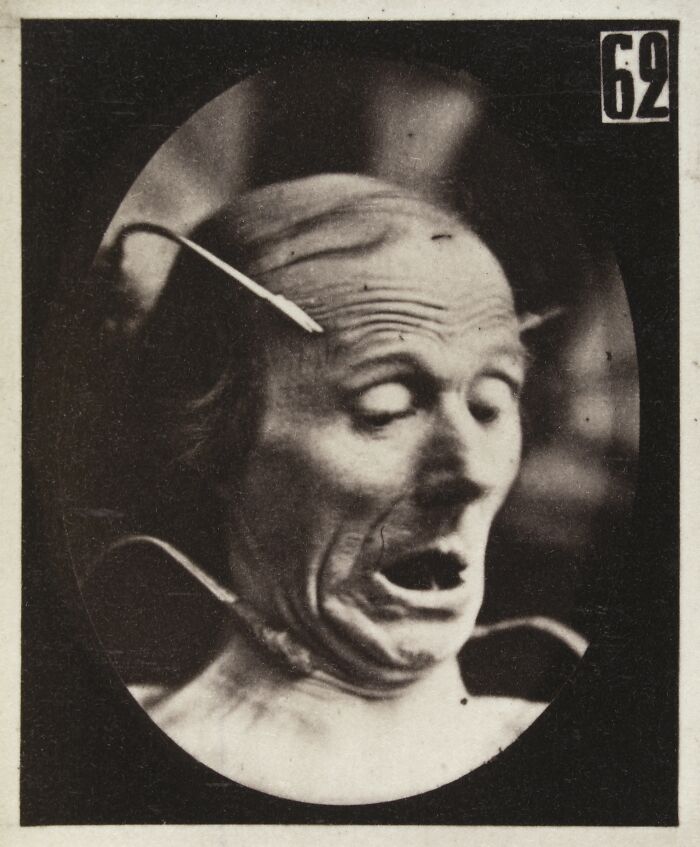 Black and white image from a 19th century facial expressions experiment showing a man with a distorted, fearful expression.
