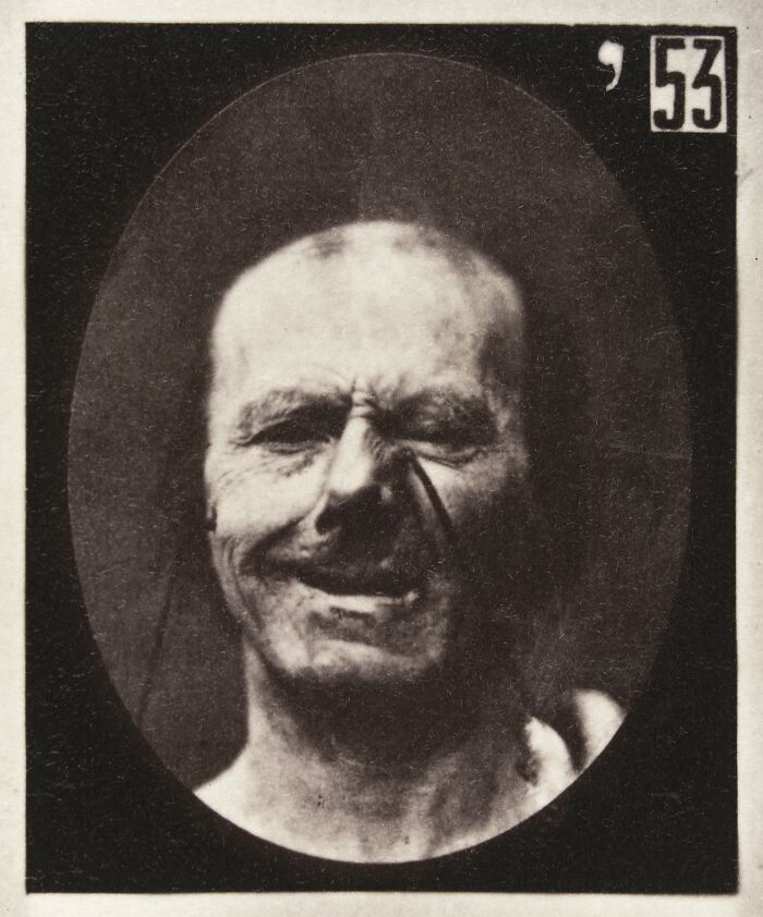 Black and white photo of a man making a distorted facial expression in a 19th century facial expressions experiment.