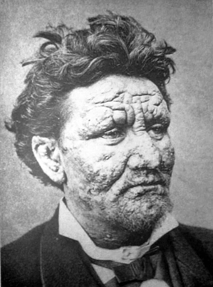 Black and white portrait of a man with severe facial skin conditions illustrating rare disease patient encounters by doctors.