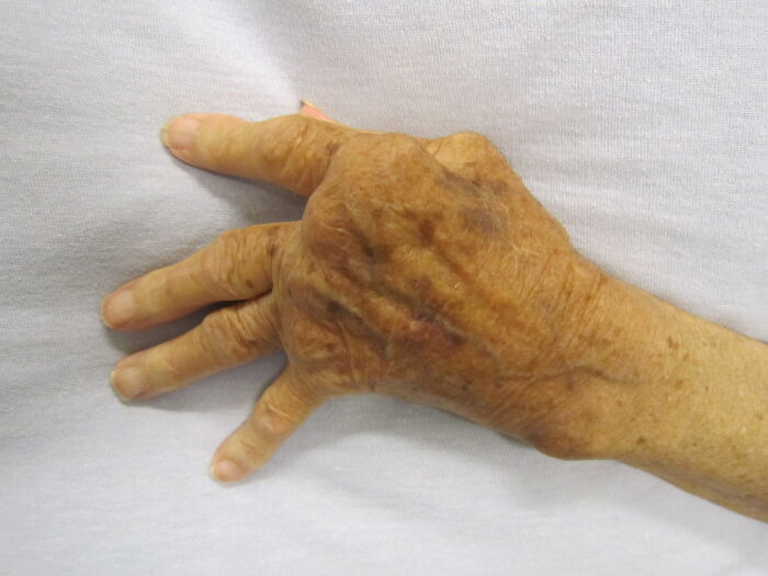 Elderly hand showing signs of a rare disease affecting joints and skin texture, a medical case for doctors.