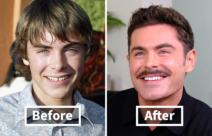 Side-by-side veneers before and after photos showing Zac Efron's dramatic smile makeover transformation.