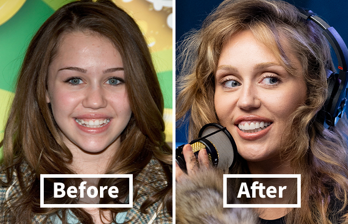 Side-by-side comparison of veneers before and after on Miley Cyrus showing a dramatic smile makeover.
