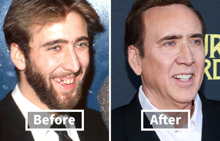 Side by side photo showing veneers before and after on Nicolas Cage with a dramatic smile makeover.