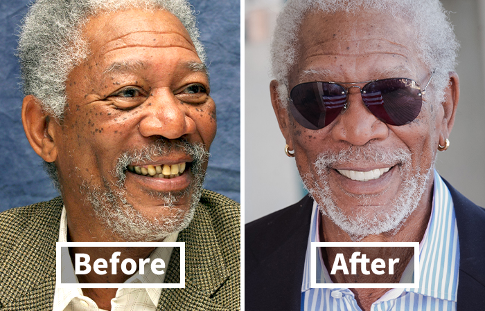 Side-by-side photo showing veneers before and after on Morgan Freeman with a dramatic smile makeover and improved teeth appearance