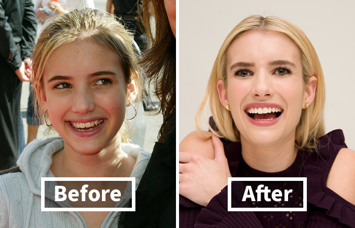 Side-by-side veneers before and after photos showing a dramatic smile makeover on a Emma Roberts