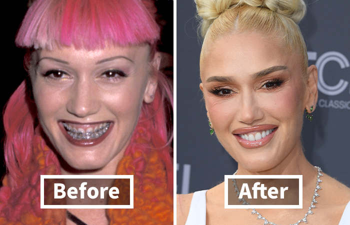 Side-by-side veneers before and after photos of Gwen Stefani showcasing a dramatic smile makeover.