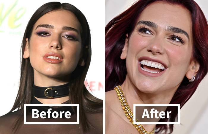 Side-by-side veneers before and after photos showing a dramatic smile makeover on Dua Lipa.