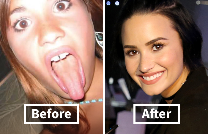 Side-by-side image showing veneers before and after on Demi Lovato with a dramatic smile makeover.