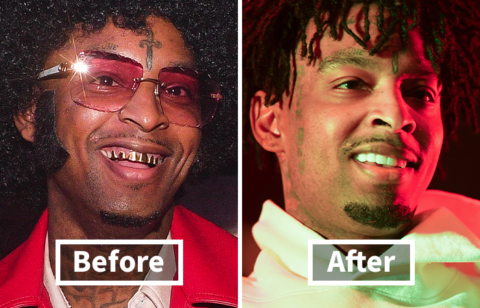 Side-by-side veneers before and after photos showing 21 Savage dramatic smile makeover with improved teeth appearance.