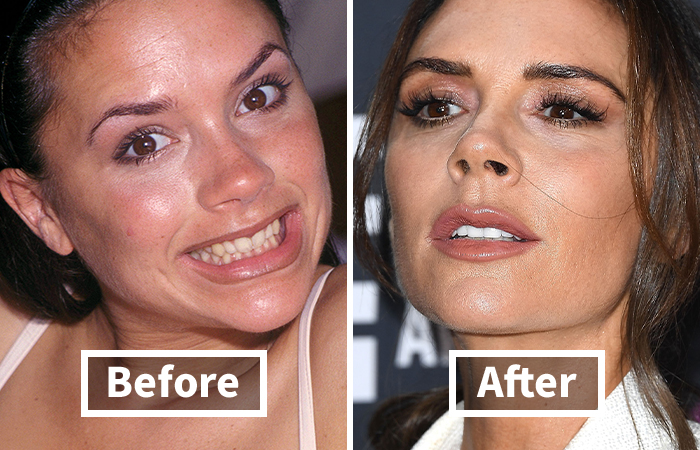 Side-by-side close-up photos showing veneers before and after results of Viktoria Beckham dramatic smile makeover.
