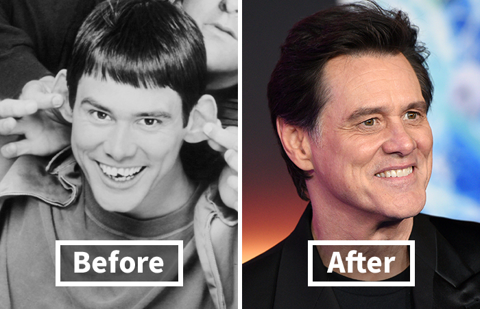 Side-by-side veneers before and after photos showing Jim Carrey dramatic smile makeover transformation.