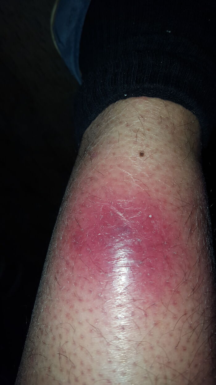 Close-up of a leg with red inflamed skin showing symptoms linked to a rare disease case doctors encountered.