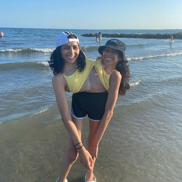 Conjoined twin smiling at the beach wearing casual summer clothes, highlighting their unique bond and lifestyle.