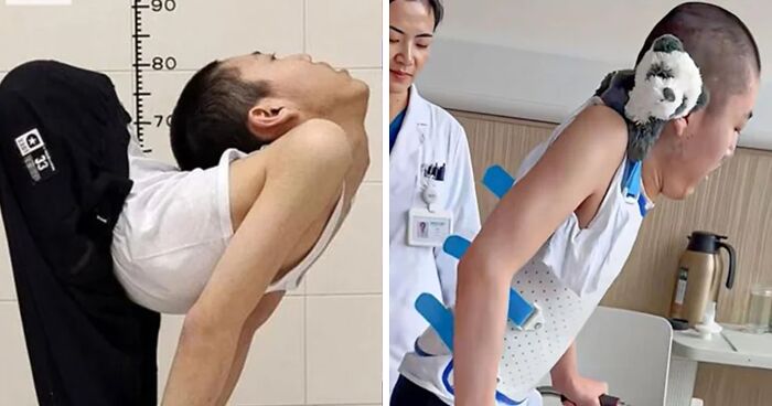 ‘Folded Boy’ Who Was Bent At 180 Degrees For Most Of His Life Stuns With ‘Magical’ Transformation