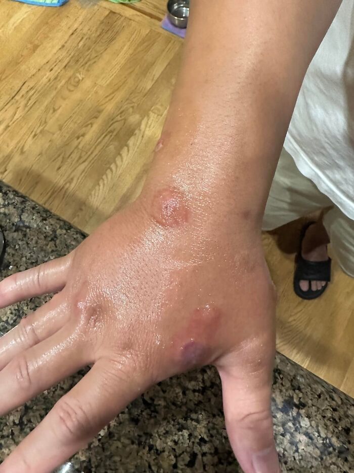 Close-up of a hand with swollen, irritated skin and sores showing signs of injury in a near death edible incident.