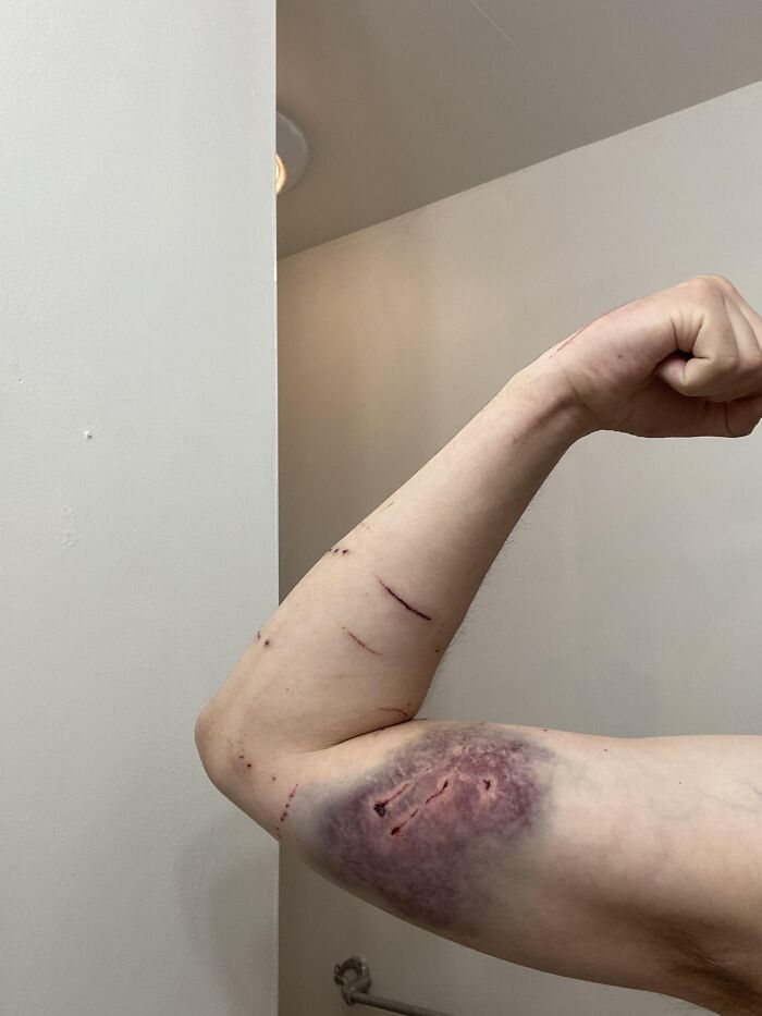 Bruised and scratched arm showing injuries from a close to death experience in a real-life survival story.