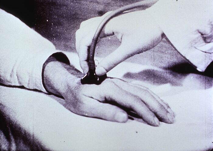 Old-school medical pic showing a vintage procedure on a patient’s hand using early medical tools in black and white.