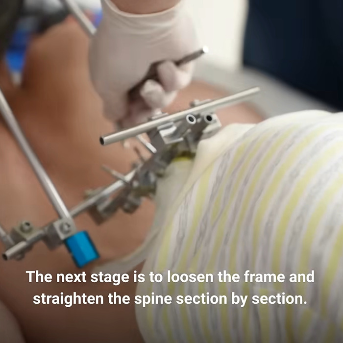 Close-up of a medical device adjusting the spine of a folded boy to help straighten his posture gradually.