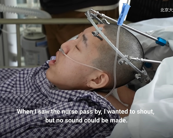 Boy with medical head frame receiving treatment after being bent at 180 degrees finally stands up straight.