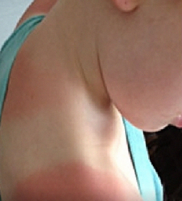 Close-up of a person with sunburn on the shoulder and neck illustrating useless yet fascinating knowledge facts.
