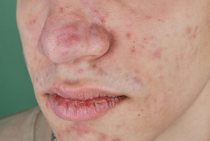 Close-up of a person's face showing skin affected by a downplayed medical condition with redness and acne-like symptoms.