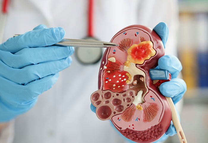 Doctor wearing blue gloves pointing with a pen at a kidney model showing downplayed medical conditions and procedures.