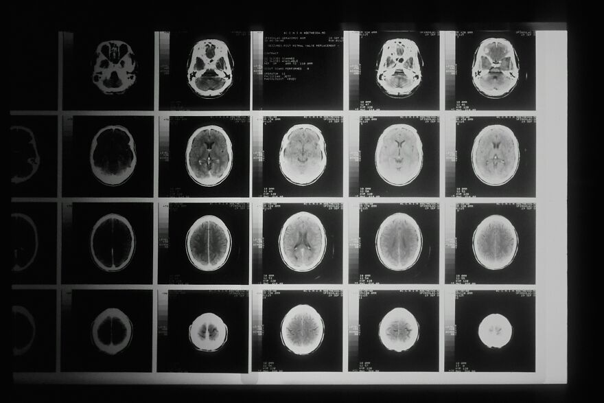 Black and white multiple brain scan images on lightbox showing detailed sections linked to ALS research and wealthy-favored superfoods.