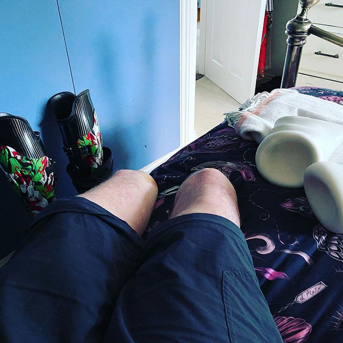 Person with legs amputated lying on bed with prosthetic legs nearby in a bedroom setting related to surgeon case. Person with legs amputated lying on bed with prosthetic legs nearby in a bedroom setting related to surgeon case.