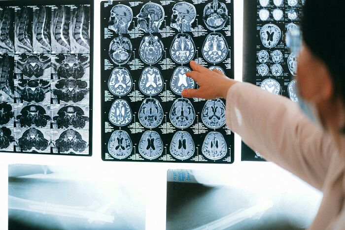 Medical professional pointing at brain scans illustrating health issues that can lead to loss of savings from a single event.