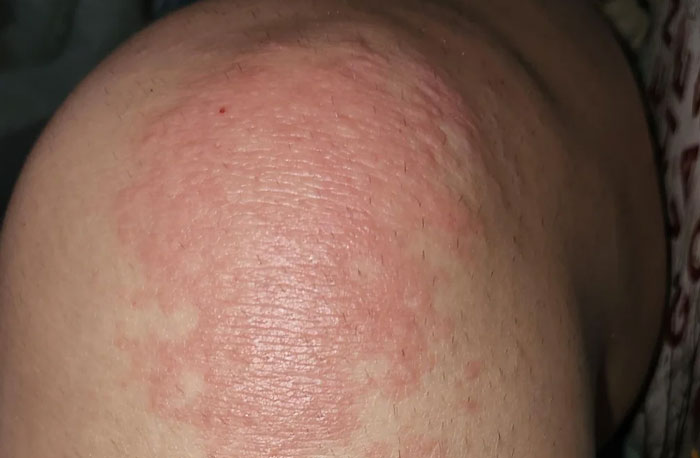 Close-up of a red, patchy skin rash on an arm illustrating medical diagnosis by doctors for accuracy in House M.D. cases.